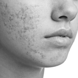 Acne Prone Skin