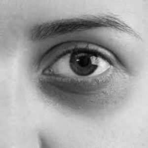 Dark Circles & Puffiness