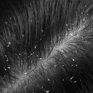 Dandruff